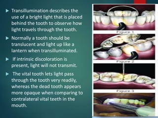  Transillumination describes the
use of a bright light that is placed
behind the tooth to observe how
light travels through the tooth.
 Normally a tooth should be
translucent and light up like a
lantern when transilluminated.
 If intrinsic discoloration is
present, light will not transmit.
 The vital tooth lets light pass
through the tooth very readily,
whereas the dead tooth appears
more opaque when comparing to
contralateral vital teeth in the
mouth.
 
