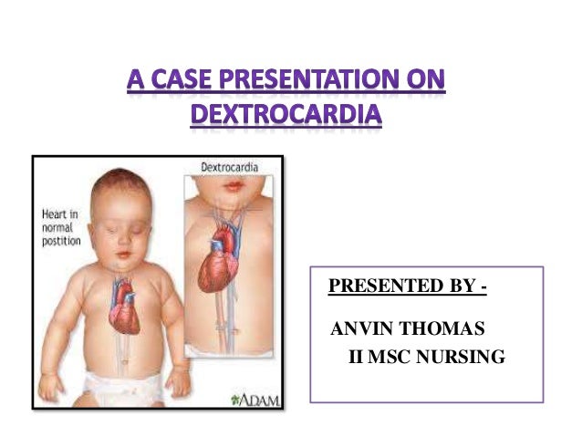 Dextro Cardia A Rare Case Dextro Cardia A Rare Case