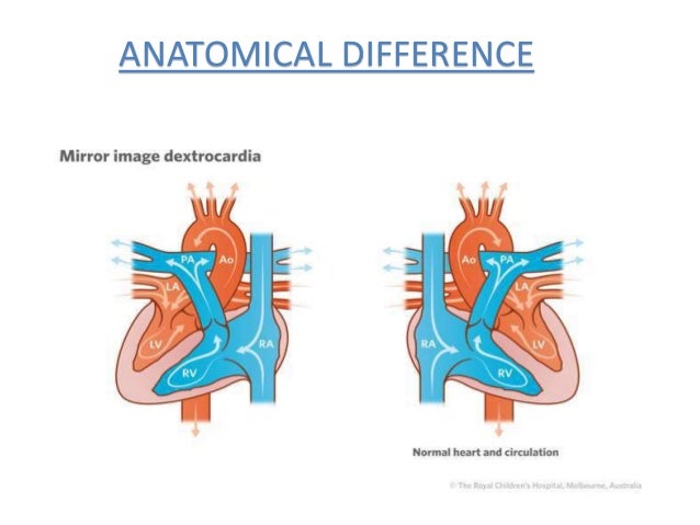 Dextro Cardia A Rare Case Dextro Cardia A Rare Case