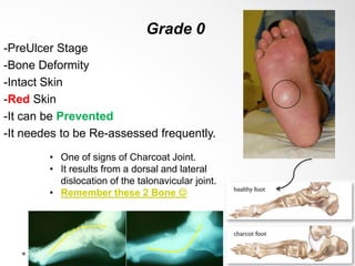 Grade 0
-PreUlcer Stage
-Bone Deformity
-Intact Skin
-Red Skin
-It can be Prevented
-It needes to be Re-assessed frequently.
• One of signs of Charcoat Joint.
• It results from a dorsal and lateral
dislocation of the talonavicular joint.
• Remember these 2 Bone 
 