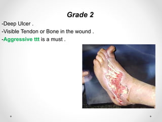 Grade 2
-Deep Ulcer .
-Visible Tendon or Bone in the wound .
-Aggressive ttt is a must .
 