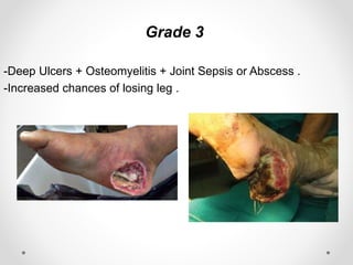 Grade 3
-Deep Ulcers + Osteomyelitis + Joint Sepsis or Abscess .
-Increased chances of losing leg .
 