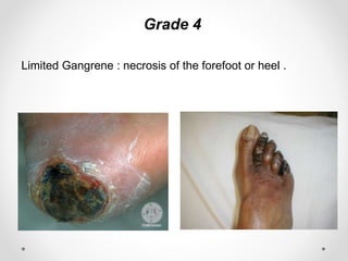 Grade 4
Limited Gangrene : necrosis of the forefoot or heel .
 