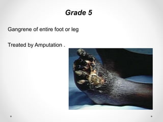 Grade 5
Gangrene of entire foot or leg
Treated by Amputation .
 
