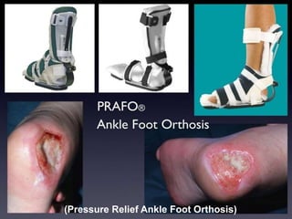 (Pressure Relief Ankle Foot Orthosis)
 