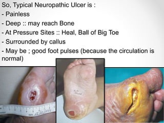 So, Typical Neuropathic Ulcer is :
- Painless
- Deep :: may reach Bone
- At Pressure Sites :: Heal, Ball of Big Toe
- Surrounded by callus
- May be ; good foot pulses (because the circulation is
normal)
 