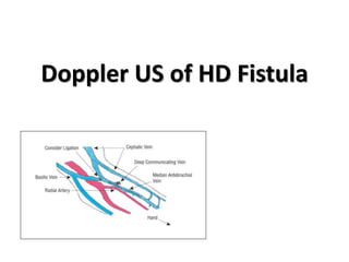 Doppler US of HD Fistula
 