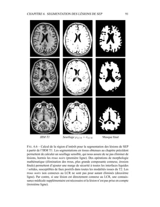CHAPITRE 6. SEGMENTATION DES LÉSIONS DE SEP 91
IRM T1 Seuillage µLCR + σLCR Masque ﬁnal
FIG. 6.6 – Calcul de la région d’intérêt pour la segmentation des lésions de SEP
à partir de l’IRM T1. Les segmentations en tissus obtenues au chapitre précédent
permettent de calculer un seuillage sensible, qui nous assure de ne pas éliminer de
lésions, hormis les trous noirs (première ligne). Des opérations de morphologie
mathématique (élimination des trous, plus grande composante connexe, érosion
ﬁnale) permettent d’ajouter une marge de sécurité à toutes les interfaces liquides
/ solides, susceptibles de faux positifs dans toutes les modalités issues du T2. Les
trous noirs non connexes au LCR ne sont pas pour autant éliminés (deuxième
ligne). Par contre, si une lésion est directement connexe au LCR, une connais-
sance médicale supplémentaire est nécessaire et la lésion n’est pas prise en compte
(troisième ligne).
 