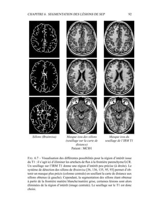 CHAPITRE 6. SEGMENTATION DES LÉSIONS DE SEP 92
Sillons (Brainvisa) Masque issu des sillons
(seuillage sur la carte de
distance)
Masque issu du
seuillage de l’IRM T1
Patient : MCI01
FIG. 6.7 – Visualisation des différentes possibilités pour la région d’intérêt issue
du T1 : il s’agit ici d’éliminer les artefacts de ﬂux à la frontière parenchyme/LCR.
Un seuillage sur l’IRM T1 donne une région d’intérêt peu précise (à droite). Le
système de détection des sillons de Brainvisa [36, 136, 135, 95, 93] permet d’ob-
tenir un masque plus précis (colonne centrale) en seuillant la carte de distance aux
sillons obtenus (à gauche). Cependant, la segmentation des sillons étant obtenue
à partir de la frontière matière blanche/matière grise, certaines lésions sont alors
éliminées de la région d’intérêt (image centrale). Le seuillage sur le T1 est donc
choisi.
 