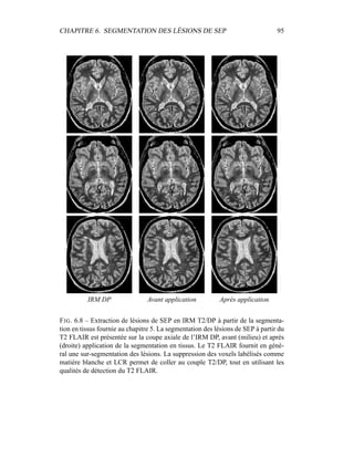 CHAPITRE 6. SEGMENTATION DES LÉSIONS DE SEP 95
IRM DP Avant application Après application
FIG. 6.8 – Extraction de lésions de SEP en IRM T2/DP à partir de la segmenta-
tion en tissus fournie au chapitre 5. La segmentation des lésions de SEP à partir du
T2 FLAIR est présentée sur la coupe axiale de l’IRM DP, avant (milieu) et après
(droite) application de la segmentation en tissus. Le T2 FLAIR fournit en géné-
ral une sur-segmentation des lésions. La suppression des voxels labélisés comme
matière blanche et LCR permet de coller au couple T2/DP, tout en utilisant les
qualités de détection du T2 FLAIR.
 