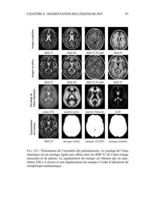 CHAPITRE 6. SEGMENTATION DES LÉSIONS DE SEP 97
IRM T2 IRM DP IRM T2 FLAIR IRM T1
IRM T2 IRM DP IRM T2 FLAIR IRM T1
atlas (T2) matière grise matière blanche LCR
IRM T2 masque (atlas) masque (T2/DP) masque résultat
FIG. 6.9 – Présentation de l’ensemble des prétraitements. Le recalage de l’atlas
statistique est un recalage rigide puis afﬁne entre les IRM T2 de l’atlas (image
moyenne) et du patient. La segmentation du masque est obtenue par un algo-
rithme EM à 4 classes et une régularisation du masque à l’aide d’opérations de
morphologie mathématique.
 