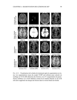 CHAPITRE 6. SEGMENTATION DES LÉSIONS DE SEP 99
IRM T2 FLAIR Seuillage auto. Lésions (Fl.) Lésions (DP)
IRM T1 Seuillage auto. Érosion Lésions (DP)
IRM T2 IRM DP Segmentation Lésions (DP)
Lésions (T2) Lésions (DP) Lésions (Fl.) Lésions (T1)
FIG. 6.11 – Visualisation de la chaîne de traitement après la segmentation en tis-
sus. Les segmentations issues du couple T2/DP sont utilisées pour calculer un
seuillage en T2 FLAIR (détection des lésions), et en T1 (segmentation du paren-
chyme cérébral). Les voxels labélisés comme de la matière blanche ou du LCR
sont alors supprimés du masque des lésions dans la version ﬁnale du résultat.
 