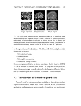 CHAPITRE 7. PRÉSENTATION DES RÉSULTATS ET ÉVALUATION 103
Images originales Images recalées Patient moyen
FIG. 7.1 – Une coupe coronale de deux patients différents est ici visualisée, avant
et après recalage sur le patient moyen. Avant d’effectuer le contourage manuel
des lésions, les images sont recalées sur un patient moyen ﬁxé. S’assurer que
chaque patient a le même nombre de coupes à segmenter permet d’uniformiser la
sensibilité du contourage manuel et ainsi de faciliter le travail de l’opérateur.
est alors grossièrement le même (ﬁgure 7.1). Chacune des lésions a également été
classée dans 4 catégories :
– lésions juxtacorticales,
– lésions corticales,
– lésions périventriculaires,
– lésions de la fosse postérieure.
Nous avons également labélisé les lésions nécrotiques, dont le signal en IRM T2
FLAIR est différent de celui des autres lésions. Ces catégories ne sont pas exclu-
sives ; elles permettent par contre de préciser les résultats pour différentes lésions
dont les caractéristiques – taille, contraste, localisation – varient fortement.
7.2 Introduction à l’évaluation quantitative
Prenons le cas d’un test pharmaceutique sensé détecter si un sujet est sain (test
négatif) ou malade (test positif). Pour valider l’efﬁcacité du test, ce dernier est
appliqué sur une base de sujets, sains ou malades. 4 populations vont se distinguer.
 
