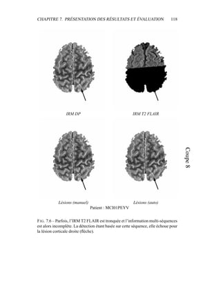 CHAPITRE 7. PRÉSENTATION DES RÉSULTATS ET ÉVALUATION 118
IRM DP IRM T2 FLAIR
Lésions (manuel) Lésions (auto)
Patient : MCI01PEYV
FIG. 7.6 – Parfois, l’IRM T2 FLAIR est tronquée et l’information multi-séquences
est alors incomplète. La détection étant basée sur cette séquence, elle échoue pour
la lésion corticale droite (ﬂèche).
 