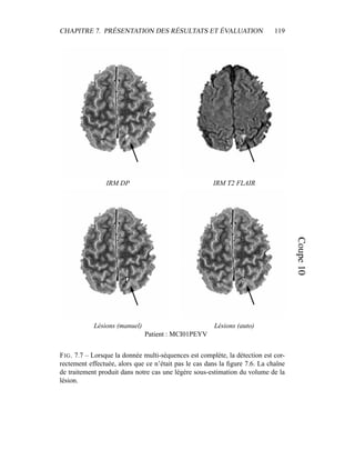 CHAPITRE 7. PRÉSENTATION DES RÉSULTATS ET ÉVALUATION 119
IRM DP IRM T2 FLAIR
Lésions (manuel) Lésions (auto)
Patient : MCI01PEYV
FIG. 7.7 – Lorsque la donnée multi-séquences est complète, la détection est cor-
rectement effectuée, alors que ce n’était pas le cas dans la ﬁgure 7.6. La chaîne
de traitement produit dans notre cas une légère sous-estimation du volume de la
lésion.
 