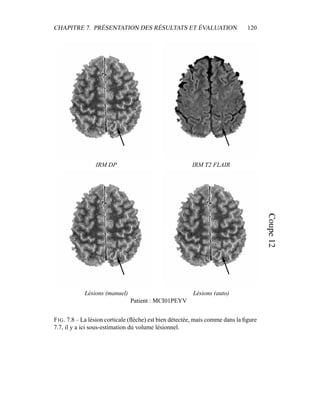 CHAPITRE 7. PRÉSENTATION DES RÉSULTATS ET ÉVALUATION 120
IRM DP IRM T2 FLAIR
Lésions (manuel) Lésions (auto)
Patient : MCI01PEYV
FIG. 7.8 – La lésion corticale (ﬂèche) est bien détectée, mais comme dans la ﬁgure
7.7, il y a ici sous-estimation du volume lésionnel.
 