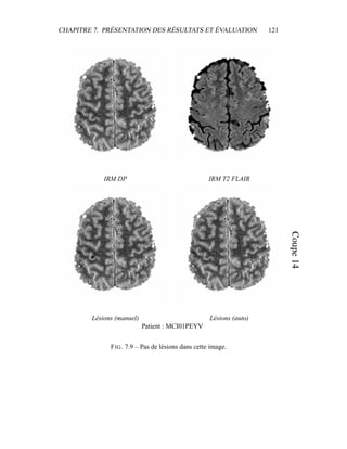 CHAPITRE 7. PRÉSENTATION DES RÉSULTATS ET ÉVALUATION 121
IRM DP IRM T2 FLAIR
Lésions (manuel) Lésions (auto)
Patient : MCI01PEYV
FIG. 7.9 – Pas de lésions dans cette image.
 