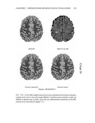 CHAPITRE 7. PRÉSENTATION DES RÉSULTATS ET ÉVALUATION 122
IRM DP IRM T2 FLAIR
Lésions (manuel) Lésions (auto)
Patient : MCI01PEYV
FIG. 7.10 – Le FLAIR conduit souvent à la sous-estimation des lésions corticales,
comme on le voit ici sur cette coupe (ﬂèche). La lésion juxta-corticale, à côté, est
difﬁcile à détecter par sa taille, mais elle est sufﬁsamment contrastée en FLAIR,
comme on le verra dans la ﬁgure 7.11.
 
