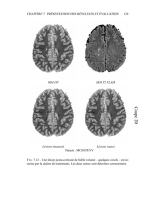 CHAPITRE 7. PRÉSENTATION DES RÉSULTATS ET ÉVALUATION 124
IRM DP IRM T2 FLAIR
Lésions (manuel) Lésions (auto)
Patient : MCI01PEYV
FIG. 7.12 – Une lésion juxta-corticale de faible volume – quelques voxels – est ici
omise par la chaîne de traitements. Les deux autres sont détectées correctement.
 