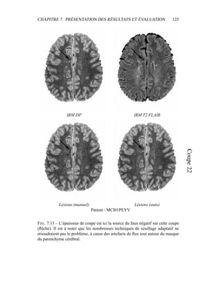 CHAPITRE 7. PRÉSENTATION DES RÉSULTATS ET ÉVALUATION 125
IRM DP IRM T2 FLAIR
Lésions (manuel) Lésions (auto)
Patient : MCI01PEYV
FIG. 7.13 – L’épaisseur de coupe est ici la source du faux négatif sur cette coupe
(ﬂèche). Il est à noter que les nombreuses techniques de seuillage adaptatif ne
résoudraient pas le problème, à cause des artefacts de ﬂux tout autour du masque
du parenchyme cérébral.
 