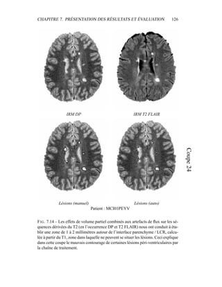 CHAPITRE 7. PRÉSENTATION DES RÉSULTATS ET ÉVALUATION 126
IRM DP IRM T2 FLAIR
Lésions (manuel) Lésions (auto)
Patient : MCI01PEYV
FIG. 7.14 – Les effets de volume partiel combinés aux artefacts de ﬂux sur les sé-
quences dérivées du T2 (en l’occurrence DP et T2 FLAIR) nous ont conduit à éta-
blir une zone de 1 à 2 millimètres autour de l’interface parenchyme / LCR, calcu-
lée à partir du T1, zone dans laquelle ne peuvent se situer les lésions. Ceci explique
dans cette coupe le mauvais contourage de certaines lésions péri-ventriculaires par
la chaîne de traitement.
 