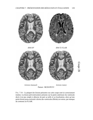 CHAPITRE 7. PRÉSENTATION DES RÉSULTATS ET ÉVALUATION 128
IRM DP IRM T2 FLAIR
Lésions (manuel) Lésions (auto)
Patient : MCI01PEYV
FIG. 7.16 – La plupart des lésions présentes sur cette coupe sont ici correctement
traitées. La lésion périventriculaire présente sur la partie antérieure du ventricule
droit n’est pas simple à détecter de part sa taille et sa localisation, alors qu’une
petite lésion juxta-corticale à droite des ventricules (ﬂèche) est omise, par manque
de contraste en FLAIR.
 