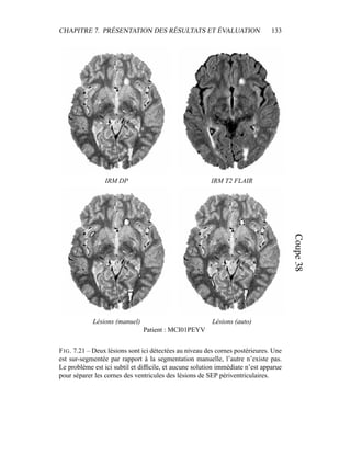 CHAPITRE 7. PRÉSENTATION DES RÉSULTATS ET ÉVALUATION 133
IRM DP IRM T2 FLAIR
Lésions (manuel) Lésions (auto)
Patient : MCI01PEYV
FIG. 7.21 – Deux lésions sont ici détectées au niveau des cornes postérieures. Une
est sur-segmentée par rapport à la segmentation manuelle, l’autre n’existe pas.
Le problème est ici subtil et difﬁcile, et aucune solution immédiate n’est apparue
pour séparer les cornes des ventricules des lésions de SEP périventriculaires.
 