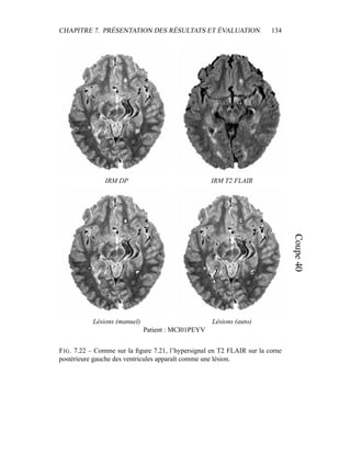 CHAPITRE 7. PRÉSENTATION DES RÉSULTATS ET ÉVALUATION 134
IRM DP IRM T2 FLAIR
Lésions (manuel) Lésions (auto)
Patient : MCI01PEYV
FIG. 7.22 – Comme sur la ﬁgure 7.21, l’hypersignal en T2 FLAIR sur la corne
postérieure gauche des ventricules apparaît comme une lésion.
 