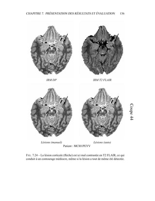 CHAPITRE 7. PRÉSENTATION DES RÉSULTATS ET ÉVALUATION 136
IRM DP IRM T2 FLAIR
Lésions (manuel) Lésions (auto)
Patient : MCI01PEYV
FIG. 7.24 – La lésion corticale (ﬂèche) est ici mal contrastée en T2 FLAIR, ce qui
conduit à un contourage médiocre, même si la lésion a tout de même été détectée.
 