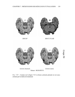 CHAPITRE 7. PRÉSENTATION DES RÉSULTATS ET ÉVALUATION 139
IRM DP IRM T2 FLAIR
Lésions (manuel) Lésions (auto)
Patient : MCI01PEYV
FIG. 7.27 – Comme sur la ﬁgure 7.27, la lésion corticale présente ici est sous-
estimée par la chaîne de traitement
 