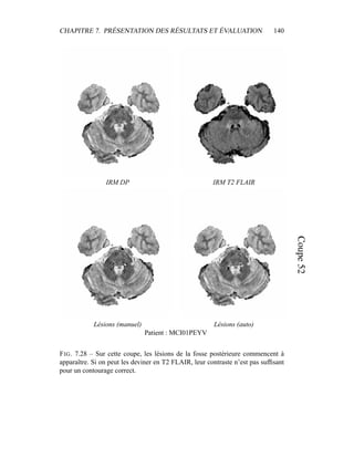CHAPITRE 7. PRÉSENTATION DES RÉSULTATS ET ÉVALUATION 140
IRM DP IRM T2 FLAIR
Lésions (manuel) Lésions (auto)
Patient : MCI01PEYV
FIG. 7.28 – Sur cette coupe, les lésions de la fosse postérieure commencent à
apparaître. Si on peut les deviner en T2 FLAIR, leur contraste n’est pas sufﬁsant
pour un contourage correct.
 
