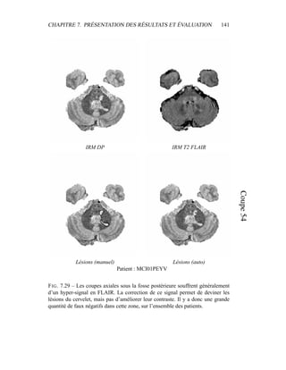 CHAPITRE 7. PRÉSENTATION DES RÉSULTATS ET ÉVALUATION 141
IRM DP IRM T2 FLAIR
Lésions (manuel) Lésions (auto)
Patient : MCI01PEYV
FIG. 7.29 – Les coupes axiales sous la fosse postérieure souffrent généralement
d’un hyper-signal en FLAIR. La correction de ce signal permet de deviner les
lésions du cervelet, mais pas d’améliorer leur contraste. Il y a donc une grande
quantité de faux négatifs dans cette zone, sur l’ensemble des patients.
 