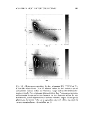 CHAPITRE 8. DISCUSSION ET PERSPECTIVES 146
IRM T2
IRMT1
IRM T2
IRMT1
FIG. 8.1 – Histogrammes conjoints de deux séquences IRM (T2 FSE et T1).
L’IRM T1 a été recalée sur l’IRM T2. Alors qu’en haut, les deux séquences ont été
correctement recalées, en bas, une rotation de 1 degré a été ajoutée à la transfor-
mation optimale. Ceci est alors parfaitement visible dans l’histogramme conjoint,
et l’estimation des paramètres de classes en est alors fortement altérée. La ma-
tière blanche, dont le rapport surface / volume est faible, est peu touchée par ce
phénomène. Par contre, l’effet sur la segmentation du LCR est très important : la
variance de cette classe a été multipliée par 10.
 