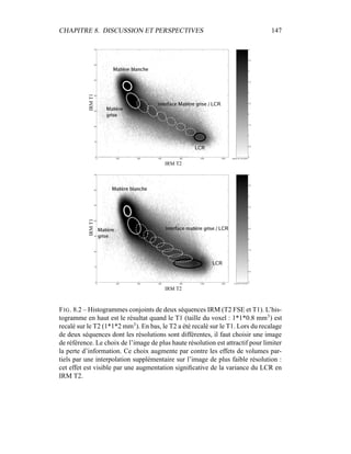 CHAPITRE 8. DISCUSSION ET PERSPECTIVES 147
IRM T2
IRMT1
IRM T2
IRMT1
FIG. 8.2 – Histogrammes conjoints de deux séquences IRM (T2 FSE et T1). L’his-
togramme en haut est le résultat quand le T1 (taille du voxel : 1*1*0.8 mm3
) est
recalé sur le T2 (1*1*2 mm3
). En bas, le T2 a été recalé sur le T1. Lors du recalage
de deux séquences dont les résolutions sont différentes, il faut choisir une image
de référence. Le choix de l’image de plus haute résolution est attractif pour limiter
la perte d’information. Ce choix augmente par contre les effets de volumes par-
tiels par une interpolation supplémentaire sur l’image de plus faible résolution :
cet effet est visible par une augmentation signiﬁcative de la variance du LCR en
IRM T2.
 