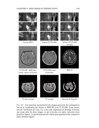 CHAPITRE 8. DISCUSSION ET PERSPECTIVES 149
Lésion (DP) Lésion (T2 FLAIR) Lésion (T2 FLAIR
corrigé)
T2 FLAIR : différence
avant / après correction
T2 FLAIR avant
correction
IRM T2
T1 non corrigé T1 corrigé Densité de Protons
FIG. 8.3 – Une mauvaise reconstruction des images peut avoir des conséquences
lors de la visualisation des lésions en IRM DP et en T2 FLAIR. Avant correc-
tion de l’inclinaison de l’axe, il y a une nette impression de décalage d’environ
une coupe entre les deux images, ce qui n’est plus vrai après correction (trois
premières lignes). Le positionnement des sillons peut également être compromis
(deux dernières lignes)
 
