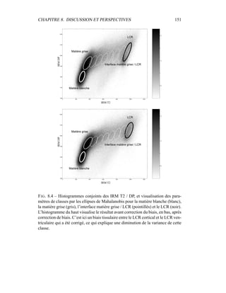 CHAPITRE 8. DISCUSSION ET PERSPECTIVES 151
0.5
1
1.5
2
2.5
0 200 400 600 800 1000 1200
600
700
800
900
1000
1100
1200
IRMDP
IRM T2
Matière blanche
Matière grise
LCR
Interface matière grise / LCR
0.5
1
1.5
2
2.5
0 200 400 600 800 1000 1200
600
700
800
900
1000
1100
1200
IRMDP
IRM T2
Matière blanche
Matière grise
LCR
Interface matière grise / LCR
FIG. 8.4 – Histogrammes conjoints des IRM T2 / DP, et visualisation des para-
mètres de classes par les ellipses de Mahalanobis pour la matière blanche (blanc),
la matière grise (gris), l’interface matière grise / LCR (pointillés) et le LCR (noir).
L’histogramme du haut visualise le résultat avant correction du biais, en bas, après
correction de biais. C’est ici un biais tissulaire entre le LCR cortical et le LCR ven-
triculaire qui a été corrigé, ce qui explique une diminution de la variance de cette
classe.
 
