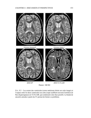 CHAPITRE 8. DISCUSSION ET PERSPECTIVES 153
Lésions (manuel) Lésions (auto.)
IRM DP IRM T2 FLAIR
Patient : MCI02
FIG. 8.5 – Les cornes des ventricules (corne antérieure droite sur cette image) et
l’espace entre les deux ventricules sur cette coupe souffrent souvent d’artefacts de
ﬂux (hypersignaux) en T2 FLAIR, qui conduisent à des faux positifs. La bande de
sécurité calculée à partir du T1 permet de limiter ce problème.
 