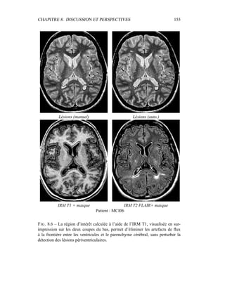 CHAPITRE 8. DISCUSSION ET PERSPECTIVES 155
Lésions (manuel) Lésions (auto.)
IRM T1 + masque IRM T2 FLAIR+ masque
Patient : MCI06
FIG. 8.6 – La région d’intérêt calculée à l’aide de l’IRM T1, visualisée en sur-
impression sur les deux coupes du bas, permet d’éliminer les artefacts de ﬂux
à la frontière entre les ventricules et le parenchyme cérébral, sans perturber la
détection des lésions périventriculaires.
 