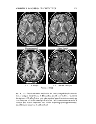 CHAPITRE 8. DISCUSSION ET PERSPECTIVES 156
Lésions (manuel) Lésions (auto.)
IRM T1 + masque IRM T2 FLAIR + masque
Patient : MCI02
FIG. 8.7 – La ﬁnesse des cornes antérieures des ventricules perturbe la construc-
tion de la région d’intérêt issue du T1 : des faux positifs sont visibles à l’extrémité
de ces cornes. De plus, le trou noir présente dans la partie antérieure gauche de
cette image est très mal contouré par le système : la lésion étant connexe au LCR
cortical, il est en effet impossible, sans critères morphologiques supplémentaires,
de différencier la nécrose du LCR cortical.
 