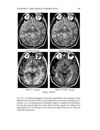 CHAPITRE 8. DISCUSSION ET PERSPECTIVES 158
Lésions (manuel) Lésions (auto.)
IRM T1 + masque IRM T2 FLAIR+ masque
Patient : MCI02
FIG. 8.8 – La sclérose en plaques n’est pas le seul problème chez ce patient : il faut
différentier les lésions de SEP de ce qui semble être une résection chirurgicale. Le
système a ici un comportement raisonnable malgré la complexité du problème.
On note par contre la détection comme lésion (en bas à gauche de l’image) d’un
hypersignal en T2 FLAIR qui n’est en fait qu’un effet de ﬂux sur les cornes de
ventricules postérieurs.
 