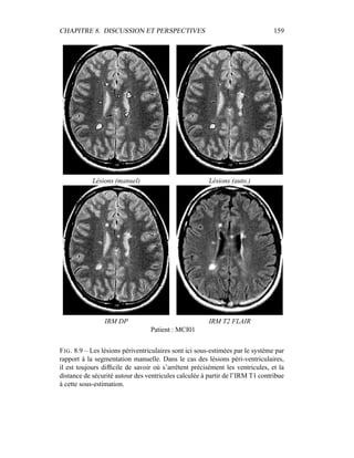 CHAPITRE 8. DISCUSSION ET PERSPECTIVES 159
Lésions (manuel) Lésions (auto.)
IRM DP IRM T2 FLAIR
Patient : MCI01
FIG. 8.9 – Les lésions périventriculaires sont ici sous-estimées par le système par
rapport à la segmentation manuelle. Dans le cas des lésions péri-ventriculaires,
il est toujours difﬁcile de savoir où s’arrêtent précisément les ventricules, et la
distance de sécurité autour des ventricules calculée à partir de l’IRM T1 contribue
à cette sous-estimation.
 