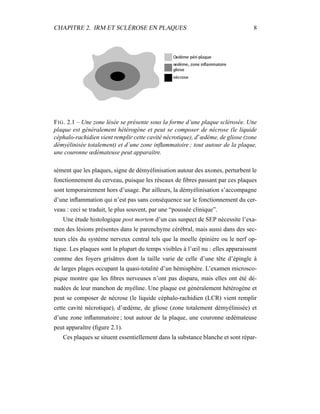 CHAPITRE 2. IRM ET SCLÉROSE EN PLAQUES 8
FIG. 2.1 – Une zone lésée se présente sous la forme d’une plaque sclérosée. Une
plaque est généralement hétérogène et peut se composer de nécrose (le liquide
céphalo-rachidien vient remplir cette cavité nécrotique), d’œdème, de gliose (zone
démyélinisée totalement) et d´une zone inﬂammatoire ; tout autour de la plaque,
une couronne œdémateuse peut apparaître.
sément que les plaques, signe de démyélinisation autour des axones, perturbent le
fonctionnement du cerveau, puisque les réseaux de ﬁbres passant par ces plaques
sont temporairement hors d’usage. Par ailleurs, la démyélinisation s’accompagne
d’une inﬂammation qui n’est pas sans conséquence sur le fonctionnement du cer-
veau : ceci se traduit, le plus souvent, par une “poussée clinique”.
Une étude histologique post mortem d’un cas suspect de SEP nécessite l’exa-
men des lésions présentes dans le parenchyme cérébral, mais aussi dans des sec-
teurs clés du système nerveux central tels que la moelle épinière ou le nerf op-
tique. Les plaques sont la plupart du temps visibles à l’œil nu : elles apparaissent
comme des foyers grisâtres dont la taille varie de celle d’une tête d’épingle à
de larges plages occupant la quasi-totalité d’un hémisphère. L’examen microsco-
pique montre que les ﬁbres nerveuses n’ont pas disparu, mais elles ont été dé-
nudées de leur manchon de myéline. Une plaque est généralement hétérogène et
peut se composer de nécrose (le liquide céphalo-rachidien (LCR) vient remplir
cette cavité nécrotique), d’œdème, de gliose (zone totalement démyélinisée) et
d’une zone inﬂammatoire ; tout autour de la plaque, une couronne œdémateuse
peut apparaître (ﬁgure 2.1).
Ces plaques se situent essentiellement dans la substance blanche et sont répar-
 