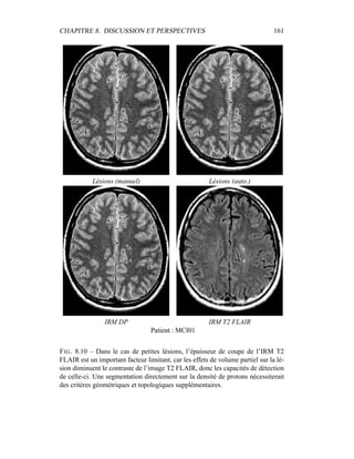 CHAPITRE 8. DISCUSSION ET PERSPECTIVES 161
Lésions (manuel) Lésions (auto.)
IRM DP IRM T2 FLAIR
Patient : MCI01
FIG. 8.10 – Dans le cas de petites lésions, l’épaisseur de coupe de l’IRM T2
FLAIR est un important facteur limitant, car les effets de volume partiel sur la lé-
sion diminuent le contraste de l’image T2 FLAIR, donc les capacités de détection
de celle-ci. Une segmentation directement sur la densité de protons nécessiterait
des critères géométriques et topologiques supplémentaires.
 