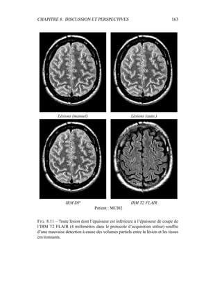 CHAPITRE 8. DISCUSSION ET PERSPECTIVES 163
Lésions (manuel) Lésions (auto.)
IRM DP IRM T2 FLAIR
Patient : MCI02
FIG. 8.11 – Toute lésion dont l’épaisseur est inférieure à l’épaisseur de coupe de
l’IRM T2 FLAIR (4 millimètres dans le protocole d’acquisition utilisé) souffre
d’une mauvaise détection à cause des volumes partiels entre la lésion et les tissus
environnants.
 