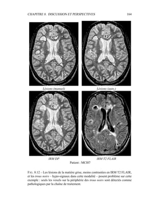 CHAPITRE 8. DISCUSSION ET PERSPECTIVES 164
Lésions (manuel) Lésions (auto.)
IRM DP IRM T2 FLAIR
Patient : MCI07
FIG. 8.12 – Les lésions de la matière grise, moins contrastées en IRM T2 FLAIR,
et les trous noirs – hypo-signaux dans cette modalité – posent problème sur cette
exemple : seuls les voxels sur la périphérie des trous noirs sont détectés comme
pathologiques par la chaîne de traitement.
 