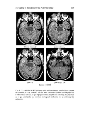 CHAPITRE 8. DISCUSSION ET PERSPECTIVES 165
Lésions (manuel) Lésions (auto.)
IRM DP IRM T2 FLAIR
Patient : MCI02
FIG. 8.13 – La lésion de SEP présente sur la partie antérieure gauche de ces coupes
est connexe au LCR cortical ; elle est donc considérée comme faisant partie de
l’extérieur du cerveau, ce qui explique les faux négatifs sur cet image. La présence
de ce qui semble être une résection chirurgicale ne facilite pas le contourage de
cette zone.
 