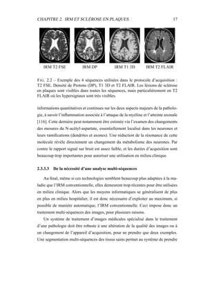 CHAPITRE 2. IRM ET SCLÉROSE EN PLAQUES 17
IRM T2 FSE IRM DP IRM T1 3D IRM T2 FLAIR
FIG. 2.2 – Exemple des 4 séquences utilisées dans le protocole d’acquisition :
T2 FSE, Densité de Protons (DP), T1 3D et T2 FLAIR. Les lésions de sclérose
en plaques sont visibles dans toutes les séquences, mais particulièrement en T2
FLAIR où les hypersignaux sont très visibles.
informations quantitatives et continues sur les deux aspects majeurs de la patholo-
gie, à savoir l’inﬂammation associée à l’attaque de la myéline et l’atteinte axonale
[116]. Cette dernière peut notamment être estimée via l’examen des changements
des mesures du N-acétyl-aspartate, essentiellement localisé dans les neurones et
leurs ramiﬁcations (dendrites et axones). Une réduction de la résonance de cette
molécule révèle directement un changement du métabolisme des neurones. Par
contre le rapport signal sur bruit est assez faible, et les durées d’acquisition sont
beaucoup trop importantes pour autoriser une utilisation en milieu clinique.
2.3.3.3 De la nécessité d’une analyse multi-séquences
Au ﬁnal, même si ces technologies semblent beaucoup plus adaptées à la ma-
ladie que l’IRM conventionnelle, elles demeurent trop récentes pour être utilisées
en milieu clinique. Alors que les moyens informatiques se généralisent de plus
en plus en milieu hospitalier, il est donc nécessaire d’exploiter au maximum, si
possible de manière automatique, l’IRM conventionnelle. Ceci impose donc un
traitement multi-séquences des images, pour plusieurs raisons.
Un système de traitement d’images médicales spécialisé dans le traitement
d’une pathologie doit être robuste à une altération de la qualité des images ou à
un changement de l’appareil d’acquisition, pour ne prendre que deux exemples.
Une segmentation multi-séquences des tissus sains permet au système de prendre
 
