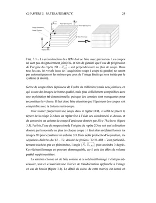 CHAPITRE 3. PRÉTRAITEMENTS 24
Vx
Vy
Repère IRM
Image Position
Image Orientation
axeZ Pixel Spacing (Vx)
Pixel Spacing (Vy)
Slice Thickness
N
FIG. 3.3 – La reconstruction des IRM doit se faire avec précaution. Les coupes
ne sont pas obligatoirement jointives, et rien de garantit que l’axe de progression
de l’origine du repère 2D –
−−→
Zaxe – soit perpendiculaire au plan de coupe. Dans
tous les cas, les voxels issus de l’acquisition coupe à coupe (à gauche) ne seront
pas automatiquement les mêmes que ceux de l’image ﬁnale qui sera traitée par le
système (à droite).
forme de coupes ﬁnes (épaisseur de l’ordre du millimètre) mais non jointives, ce
qui assure des images de bonne qualité, mais plus difﬁcilement compatibles avec
une exploitation tri-dimensionnelle, puisque des données sont manquantes pour
reconstituer le volume. Il faut donc faire attention que l’épaisseur des coupes soit
compatible avec la distance inter-coupe.
Pour insérer proprement une coupe dans le repère IRM, il sufﬁt de placer le
repère de la coupe 2D dans un repère ﬁxe à l’aide des coordonnées ci-dessus, et
de construire un volume de coupe d’épaisseur donnée par Slice Thickness (ﬁgure
3.3). Parfois, l’axe de progression de l’origine du repère 2D ne suit pas la direction
donnée par la normale au plan de chaque coupe : il faut alors rééchantillonner les
images 2D pour construire un volume 3D. Dans notre protocole d’acquisition, les
séquences dérivées du T2 – T2, densité de protons, T2 FLAIR – sont particuliè-
rement touchées par ce phénomène, l’angle (
−→
N ,
−−−→
ZAXE) peut atteindre 3 degrés.
Ce rééchantillonnage est pourtant dommageable, car il crée des effets de volume
partiel supplémentaires.
La solution choisie est de faire comme si ce rééchantillonnage n’était pas né-
cessaire, tout en conservant une matrice de transformation applicable à l’image
en cas de besoin (ﬁgure 3.4). Le détail du calcul de cette matrice est donné en
 