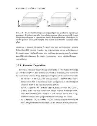 CHAPITRE 3. PRÉTRAITEMENTS 25
+ MOU
FIG. 3.4 – Un rééchantillonnage des coupes (ﬁgure de gauche) va rajouter des
problèmes de volumes partiels. Une solution consiste à faire comme si le repère
image était orthogonal et à garder une matrice de transformation afﬁne (ﬁgure de
droite) que l’on utilise, par exemple, pour recaler les différentes séquences entre
elles.
annexe de ce manuscrit (chapitre 9). Ainsi, pour tous les traitements – comme
l’algorithme EM présenté ci-après – qui ne portent que sur une seule séquence,
les images avant rééchantillonnage sont préférées ; par contre, pour le recalage
des différentes séquences, les images reconstruites – après rééchantillonnage –
sont utilisées.
3.2.3 Protocole d’acquisition
La base de données d’images utilisée dans le cadre de cette étude a été réalisée
au CHU Pasteur (Nice). Elle porte sur 34 patients et 9 témoins, pour un total de
83 acquisitions. Chacune de ces dernières suit le protocole d’acquisition suivant :
– T1 3D (TE=1.7, TR=8, FA=20, taille des voxels : 1.016*1.016*0.8 mm3
).
Sa résolution étant la meilleure de toutes les séquences, il sera utilisé pour
une étude du LCR, très sujet aux volumes partiels.
– T2/DP FSE (TE=8/100, TR=5000, ETL=16, taille des voxels 0.937, 0.937,
2 mm3
). Cette séquence fournit deux images recalées de manière intrin-
sèque. Fondamentale pour l’étude de la SEP, elle sera utilisée pour la seg-
mentation en tissus ainsi que pour rafﬁner le contourage des lésions.
– T2 FLAIR (TE=150, TR=10000, TI=2200, taille des voxels 0.937*0.937*4
mm3
). Malgré sa faible résolution en z et des artefacts de ﬂux particulière-
 