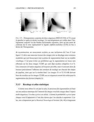 CHAPITRE 3. PRÉTRAITEMENTS 29
0
10
20
30
40
50
60
70
80
90
100
200 400 600 800 1000 1200
10
20
30
40
50
60
70
80
IRMT1
IRM T2
nombre de
points
0
10
20
30
40
50
60
70
80
90
100
100 200 300 400 500 600 700 800 900 1000 1100
10
20
30
40
50
60
70
80
IRMT1
IRM T2
nombre de
points
FIG. 3.5 – Histogrammes conjoints de deux séquences IRM (T2 FSE et T1) avant
(à gauche) et après (à droite) recalage. Un non-alignement est visible dans l’his-
togramme conjoint via des bandes horizontales rajoutées, ainsi qu’une perte de
contraste de la zone représentant le liquide céphalo-rachidien (LCR) en bas à
droite de l’histogramme.
de reconstruction, un mouvement oculaire ou une inclinaison de l’axe Z (voir
ﬁgure 3.3) dû à une mauvaise lecture des images crée un décalage entre certaines
modalités qui nuit beaucoup à tout système de segmentation basé sur un modèle
voxellique. C’est pour éviter ces problèmes que la segmentation en tissus sera
effectuée sur les deux images T2/DP, qui sont déjà recalées (chapitres 4 et 5).
Une extension à d’autres séquence est toujours possible, mais il convient alors de
mesurer précisément l’inﬂuence des artefacts de recalage sur chacune des étapes
du pipeline, ainsi que sur le résultat ﬁnal. Les images T1 et T2 FLAIR doivent
bien sûr recalées sur les images T2/DP, car ces séquences seront très utiles pour la
segmentation des lésions (chapitre 6).
3.3.3 Recalage et atlas statistique
Comme nous allons le voir par la suite, le processus de segmentation est basé
sur une analyse statistique de l’intensité de chaque voxel des images dans l’espace
multi-séquences. Un atlas a priori est utilisé : il donne la probabilité a priori pour
chaque voxel d’appartenir à l’une des classes que l’on cherche à segmenter. L’at-
las, mis à disposition par le Montreal Neurological Institute [46, 48] et largement
 